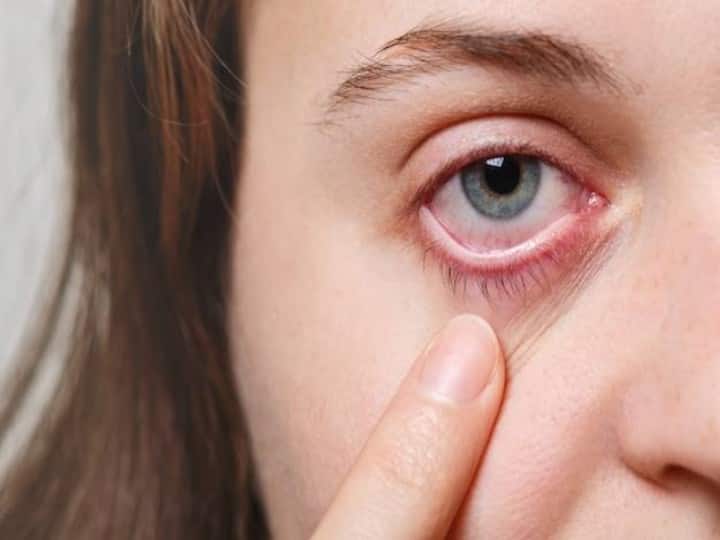 6ba58edd55cb474d64399c4ec3ea22da1691909886232506 original Eye Flu : क्यों फैल रहा आंखों का संक्रमण? जानिए आई फ्लू होने पर क्या करें और क्या नहीं